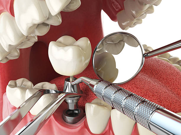 Best Emergency Dentist for Knocked-Out Tooth in West University Place, TX